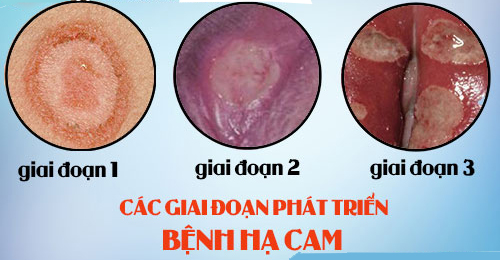 Triệu chứng bệnh hạ cam qua các giai đoạn